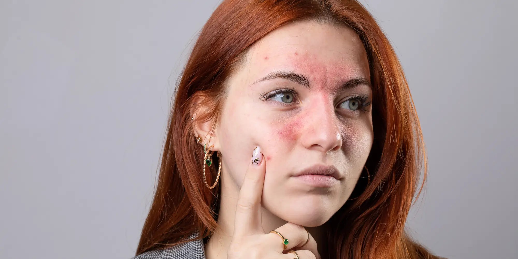 Maquiagem e Rosácea: Dicas e Produtos para Acalmar e Embelezar a Pele Sensível