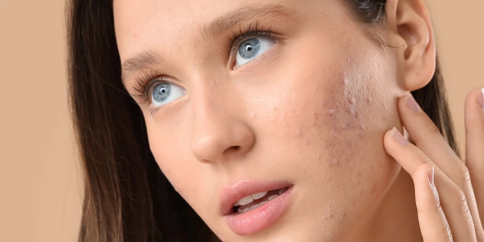 Maquiagem para peles com acne ativa: o que pode e o que evitar